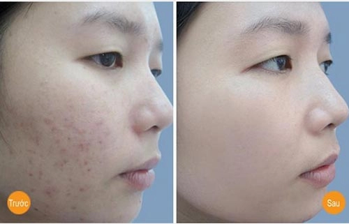 Bật mí 3 công thức làm đẹp siêu rẻ từ 1 nắm rau má