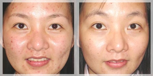 Bật mí 3 công thức làm đẹp siêu rẻ từ 1 nắm rau má