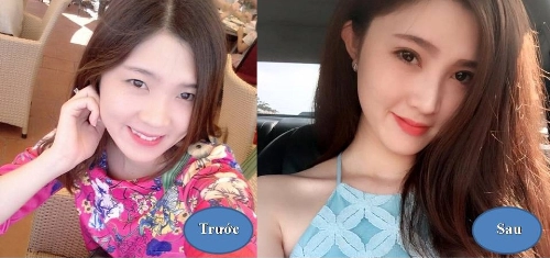 Khắc phục tình trạng mũi tẹt cho các bạn nữ