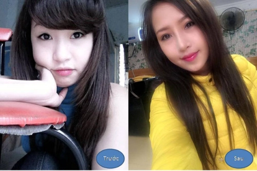 Khắc phục tình trạng mũi tẹt cho các bạn nữ