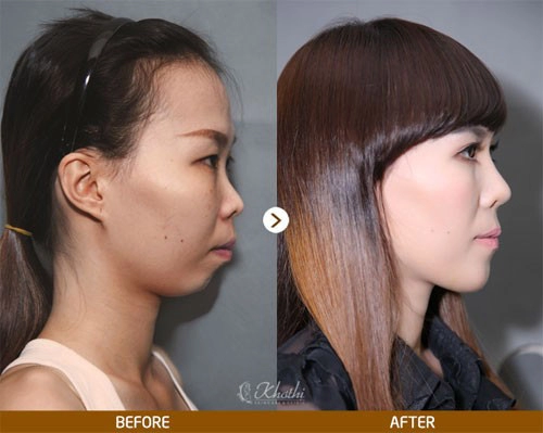 Hàng loạt sao châu á đổi vận nhờ nâng mũi