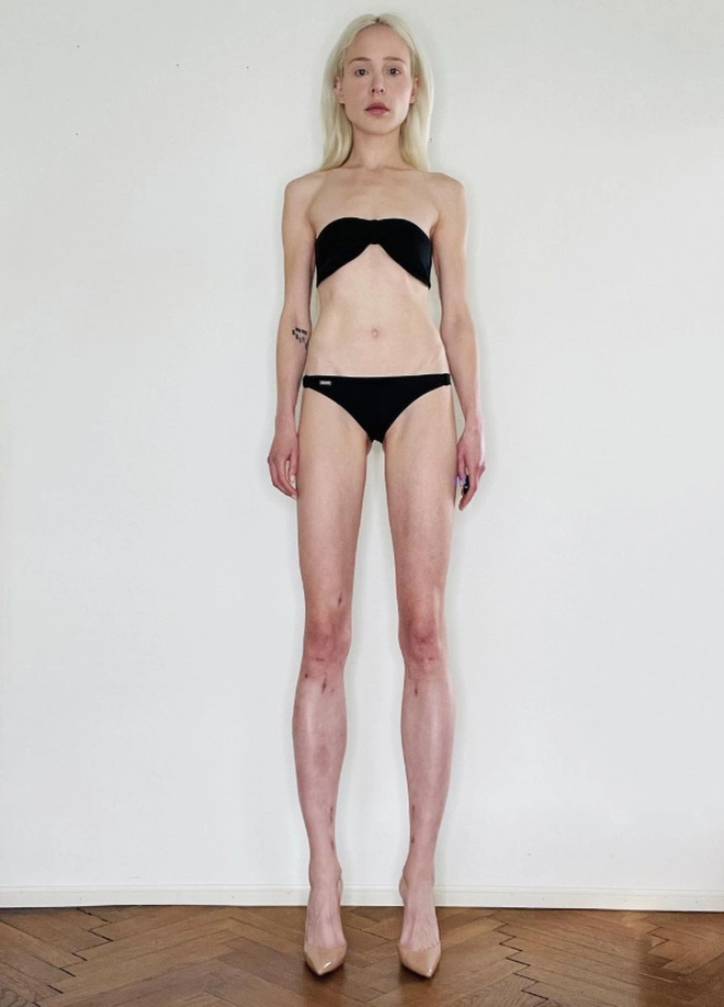 Nữ người mẫu bỏ 3 tỷ kéo dài chân để cao đến 1m8