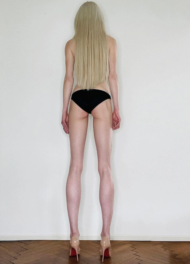Nữ người mẫu bỏ 3 tỷ kéo dài chân để cao đến 1m8
